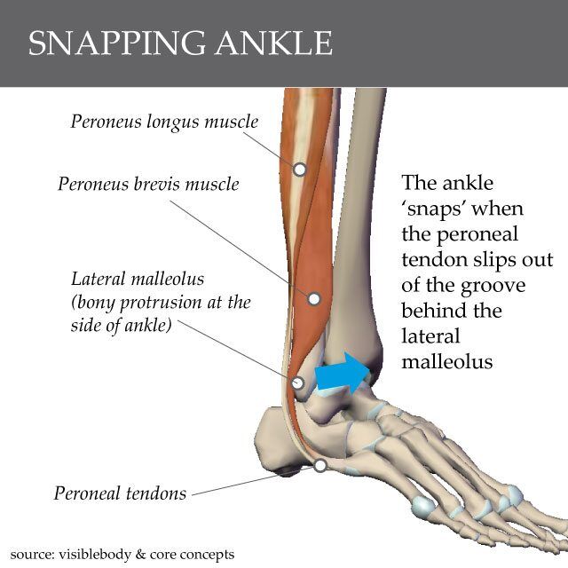 When you roll your ankle outwards, it may put the peroneal tendons on a 