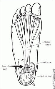 Another type of heel pain called the Heel Fat Pad Syndrome